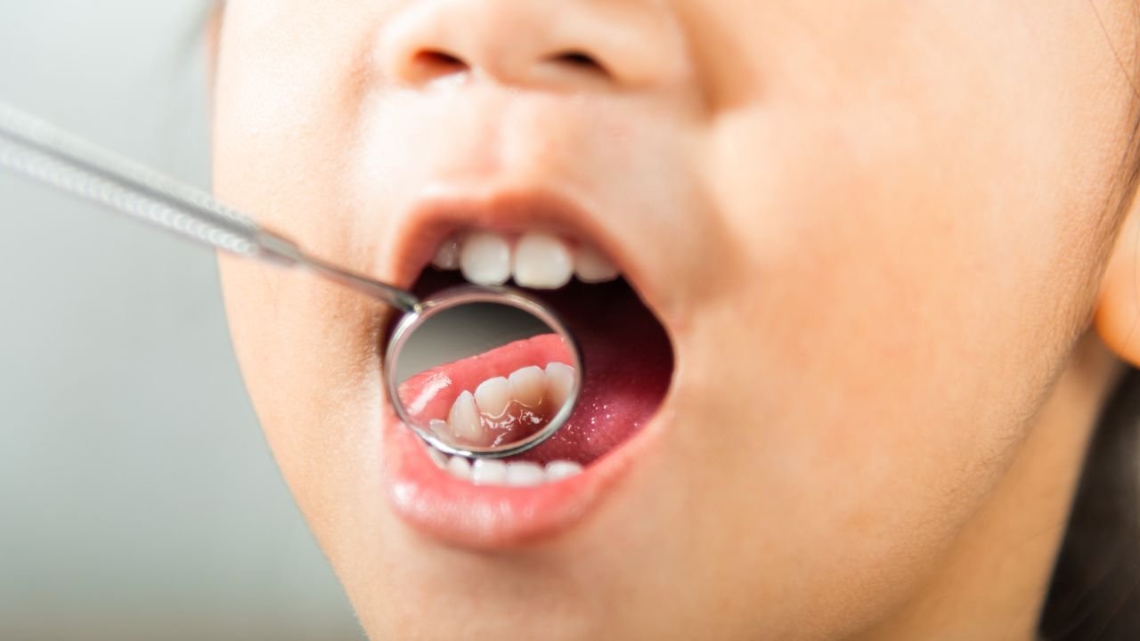 Does Drinking Coffee Cause Cavities? How Does Coffee Affect Teeth Health?